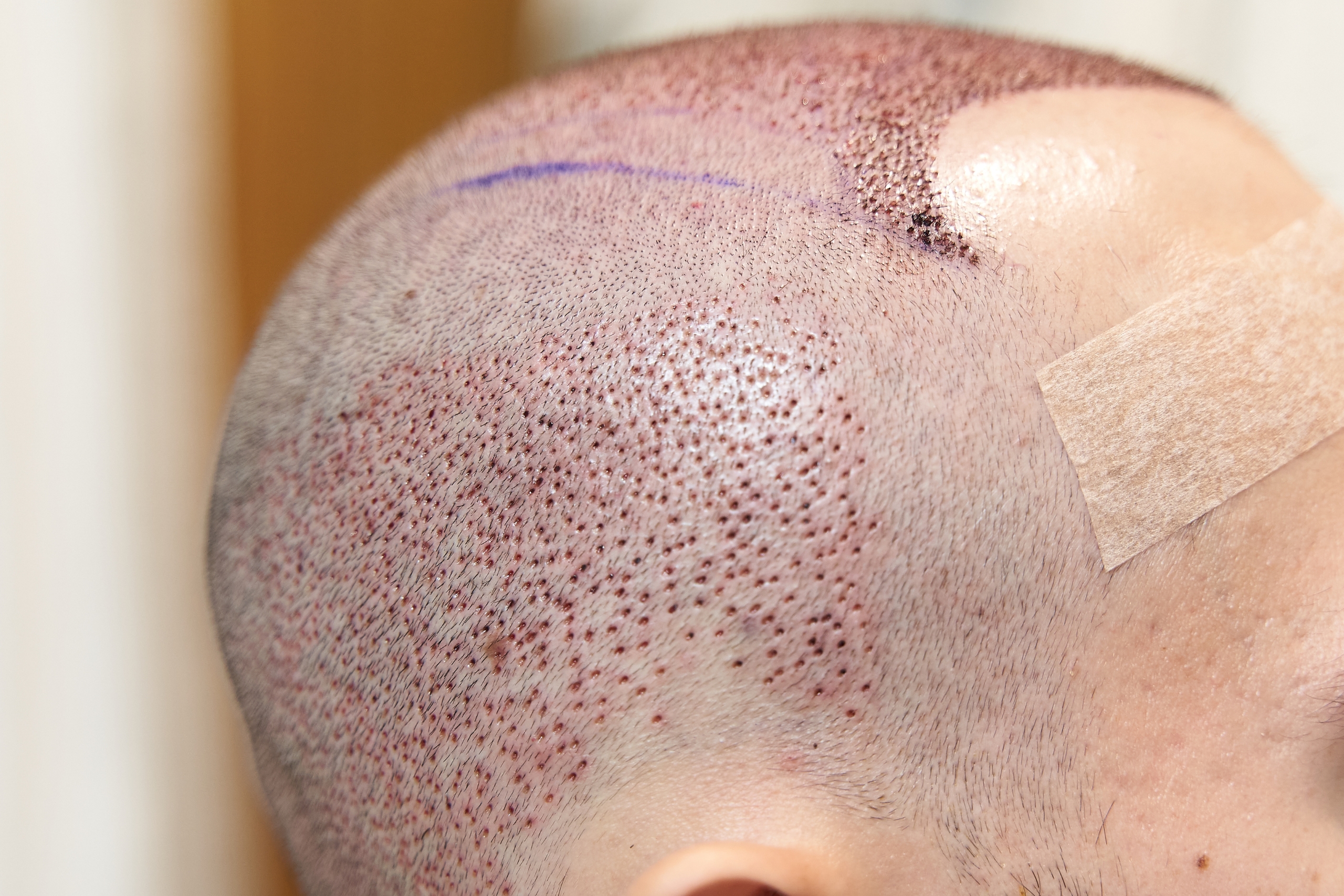 istanbul hair transplant