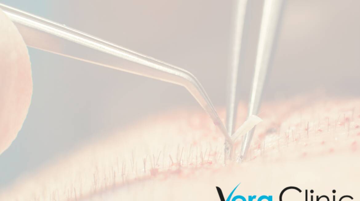 Beyond Transplants: Exploring Specialized Services Offered By Istanbul Hair Transplant Clinics
